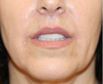 Corner Lip Lift 204 - after - front