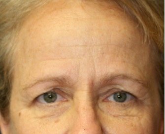 Browlift case 101 - before - front