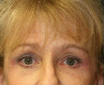 Browlift case 101 - after - front