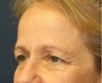Browlift case 101 - before - oblique