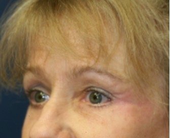 Browlift case 101 - after - oblique
