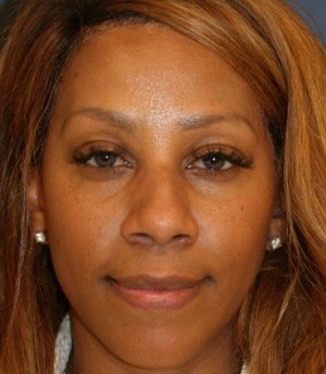 Rhinoplasty 202 - before - front