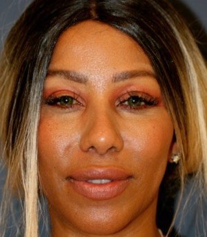 Rhinoplasty 202 - after - front