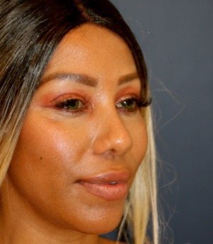 Rhinoplasty 202 - after - oblique