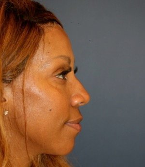 Rhinoplasty 202 - before - side