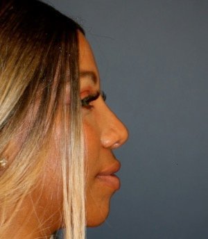 Rhinoplasty 202 - after - side
