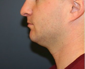 Chin Implant 202 - before - front
