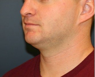 Chin Implant 202 - before - side