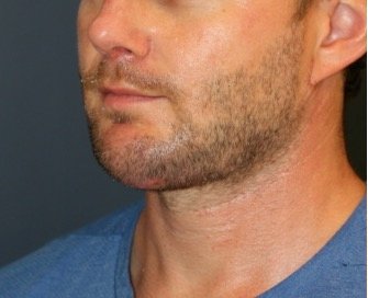 Chin Implant 202 - after - side