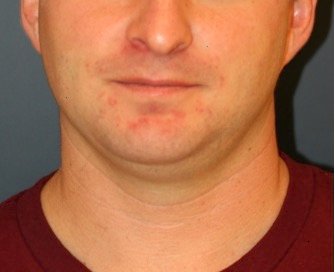 Necklift and Chin Implant 203 - before - side