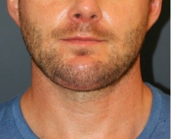 Necklift and Chin Implant 203 - after - side
