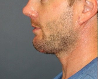 Necklift and Chin Implant 203 - after - front