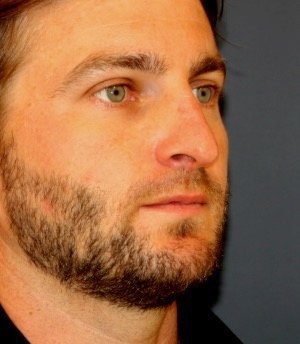Rhinoplasty 203 - before - oblique