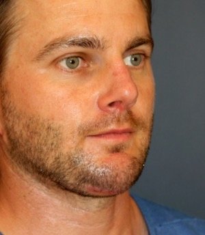 Rhinoplasty 203 - after - oblique
