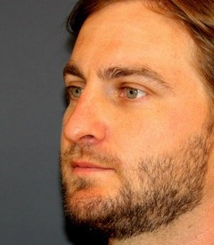 Rhinoplasty 203 - before - side