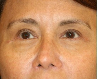 Blepharoplasty Upper Eyelids 102 - after - front