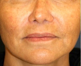 Corner of Lip Lift 205 - before - front