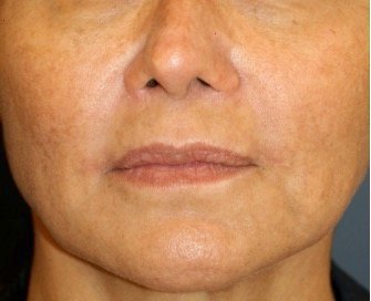 Corner of Lip Lift 205 - after - front