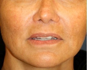 Corner of Lip Lift 205 - before - oblique