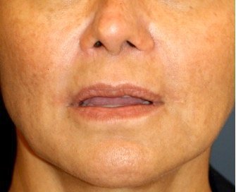 Corner of Lip Lift 205 - after - oblique