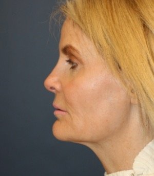 Facelift 100 - before - oblique