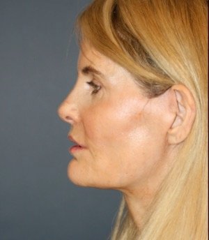 Facelift 100 - after - oblique