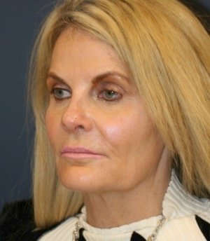 Facelift 100 - before - side