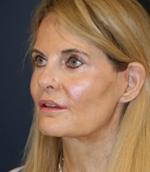 Facelift 100 - after - side