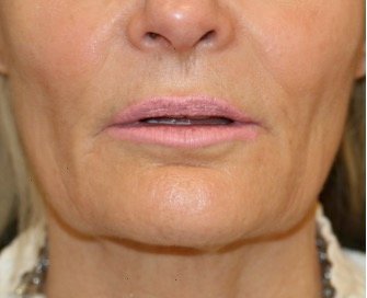 Liplift and Corner Liplift 206 - before - front