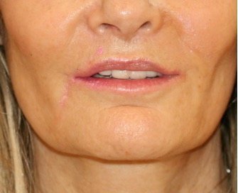 Liplift and Corner Liplift 206 - after - front