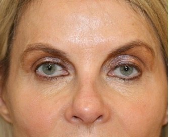 Blepharoplasty Upper Eyelids 103 - before - front