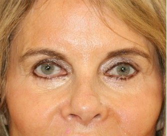 Blepharoplasty Upper Eyelids 103 - after - front