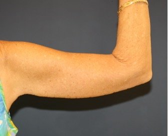 Arm Reduction 206 - after - front