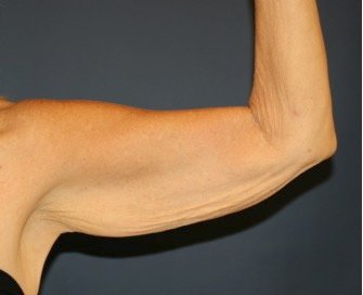 Arm Reduction 206 - before - back