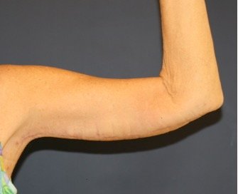 Arm Reduction 206 - after - back