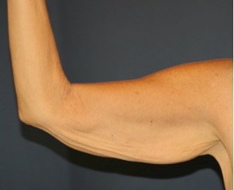Arm Reduction 207 - before - front