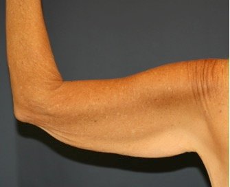Arm Reduction 207 - before - back