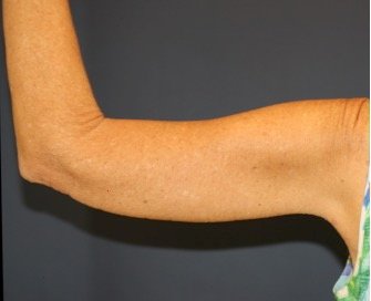 Arm Reduction 207 - after - back