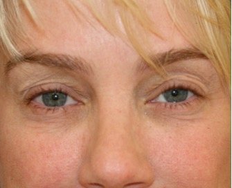 Blepharoplasty Upper Eyelids 104 - before - front