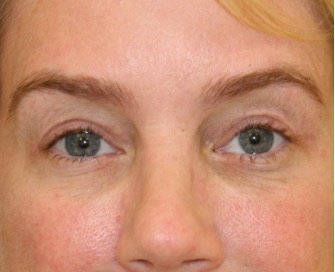 Blepharoplasty Upper Eyelids 104 - after - front