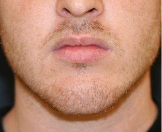 Lips Re-shaped 207 - before - front