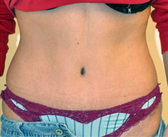 Tummy Tuck Case 2 - after - front