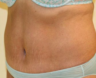 Tummy Tuck Case 6 - after - angle