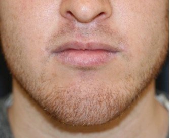 Lips Re-shaped 207 - after - front