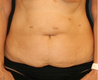 Tummy Tuck 216 - before - front
