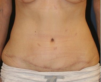 Tummy Tuck 216 - after - front