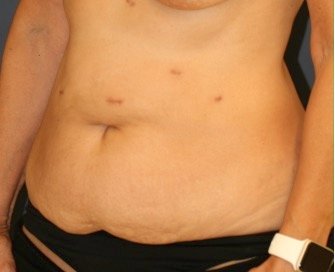 Tummy Tuck 216 - before - oblique