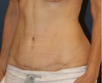 Tummy Tuck 216 - after - oblique