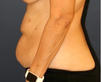 Tummy Tuck 216 - before - side