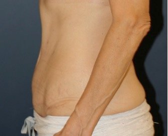 Tummy Tuck 216 - after - side